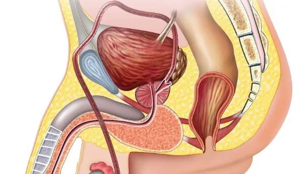 Prostatitis kronikoa